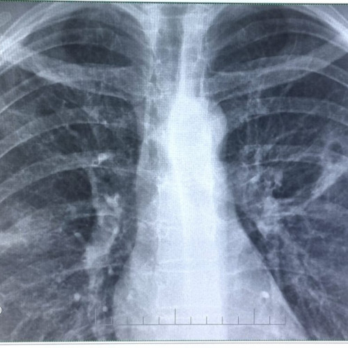 24 martie, Ziua Mondială de Luptă Împotriva Tuberculozei