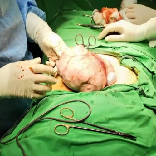 Intervenție chirurgicală reușită pentru o femeie din Iași cu un fibrom uterin uriaș