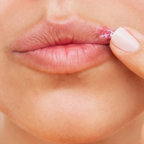 Infectiile herpetice: studii recente subliniază importanța L-lizinei în tratament