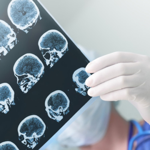 Legătura dintre pesticidele utilizate în agricultură și boala Parkinson