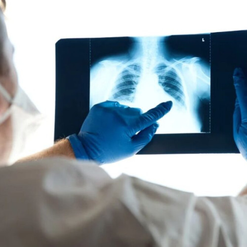 Creștere a cazurilor de gripă și viroze respiratorii în Bistrița-Năsăud