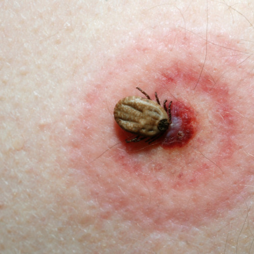 Botoșănenii suferă din cauza mușcăturilor de căpușe