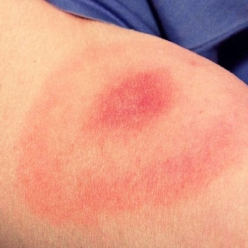 Cinci cazuri noi de mușcături de căpușe în Iași