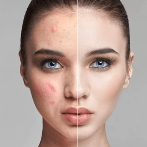 Un vaccin împotriva acneei intră în faza de testare