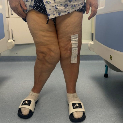 Un caz medical complicat, tratat cu succes la Spitalul de Recuperare din Iași