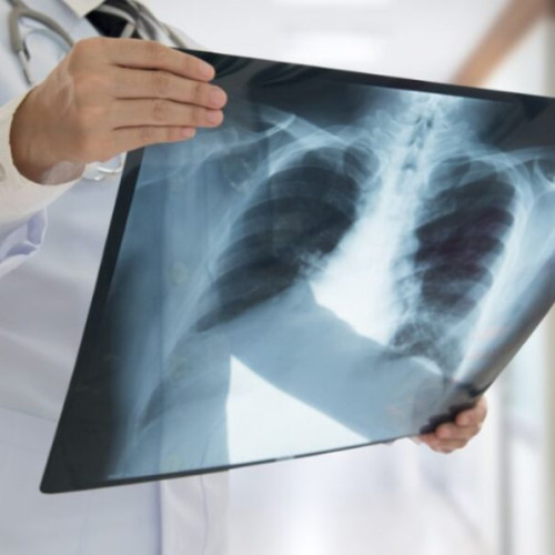 Scădere semnificativă a cazurilor de gripă și viroze respiratorii în săptămâna 21-27 aprilie 2025