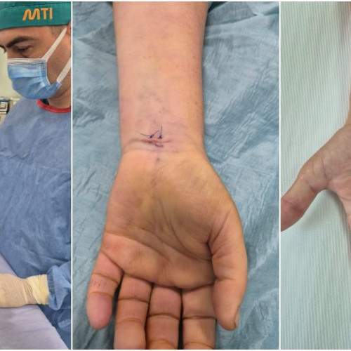 Tratament inovator pentru sindromul de tunel carpian la Spitalul Municipal Onesti