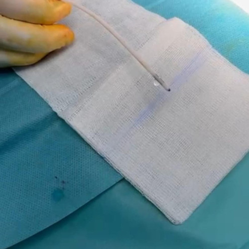 Intervenție chirurgicală de urgență salvează viața unei tinere în Arad