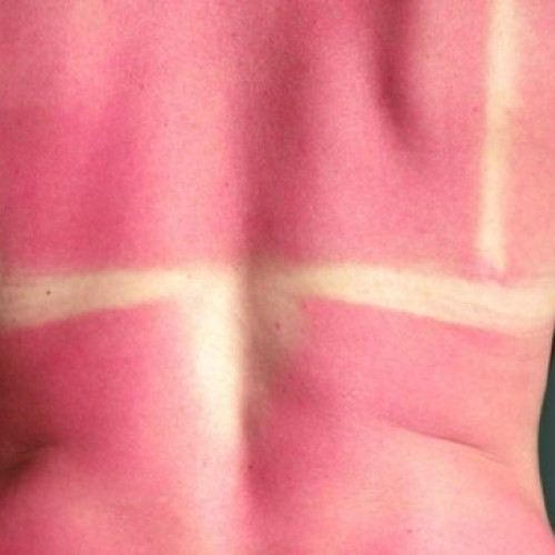 Sezonul arsurilor solare a adus noi avertizări din partea medicilor