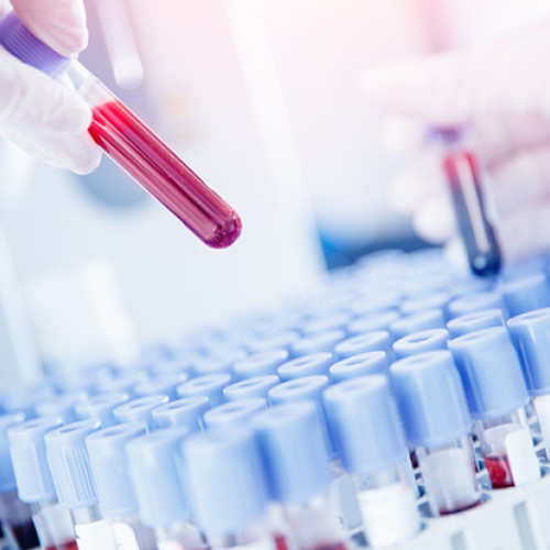 VSH: analiza de sânge importantă pentru depistarea inflamației