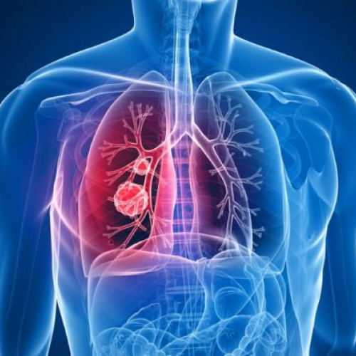 Cancerul pulmonar tot mai frecvent la persoanele nefumatoare