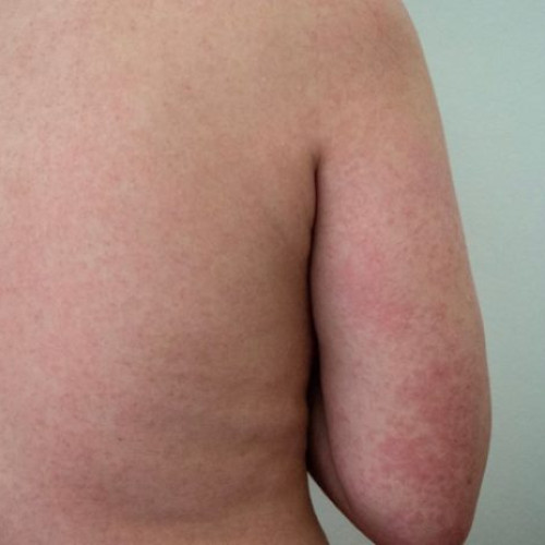 Descoperire importantă despre Rubeola: Boala contagioasă în atenția specialiștilor!