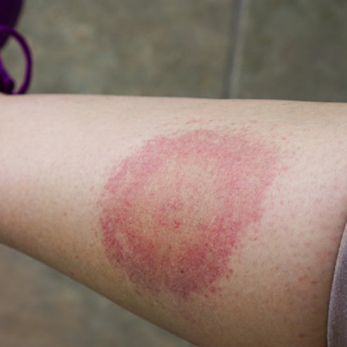 creșterea cazurilor de boala Lyme în județul Botoșani