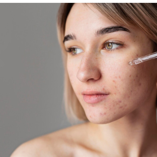 beneficii ale acidului azelaic pentru ingrijirea tenului