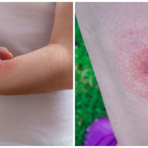 Insecte invadata în Cartierul Clujului: oamenii cer acțiuni rapide pentru combaterea țânțarilor