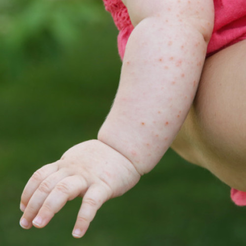 Epidemie gravă de rujeolă în Statele Unite în 2025