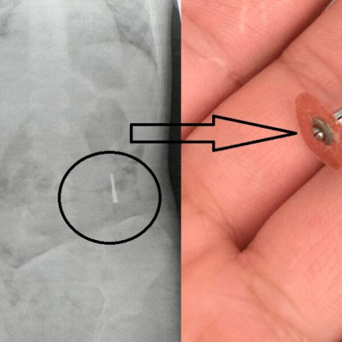 copil de cinci ani ajunge la urgenta după ce a înghițit un aparat dentar