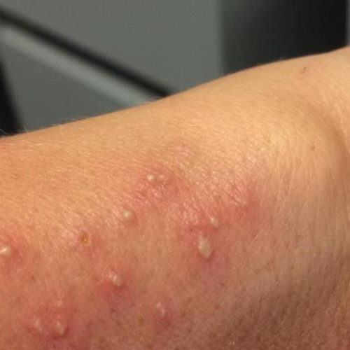 Locuitoare din Cluj-Napoca se plânge de invazie de insecte agresive în cartierul Iris