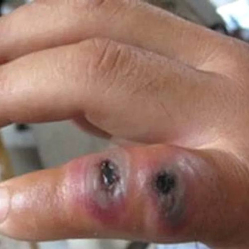 Tânăr din Ialomița diagnosticat cu antrax cutanat, mama sa decedată