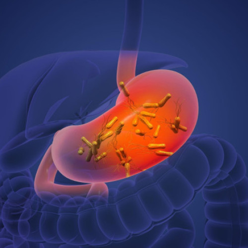 Cancerul de stomac, un pericol major global, poate fi prevenit în mare măsură