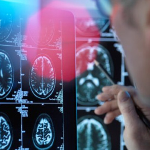 un nou medicament pentru tratarea bolii Alzheimer aproape de autorizare în Uniunea Europeană