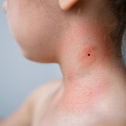 Riscuri ascunse ale muşcăturilor de capuse în perioada de vară