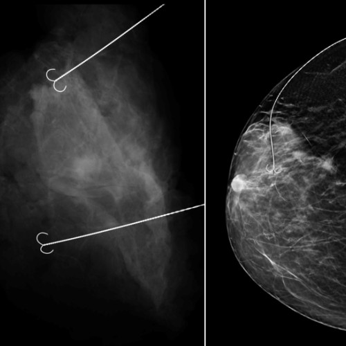 Intervenție chirurgicală reușită la Spitalul Judetean Constanța pentru tratarea cancerului mamar
