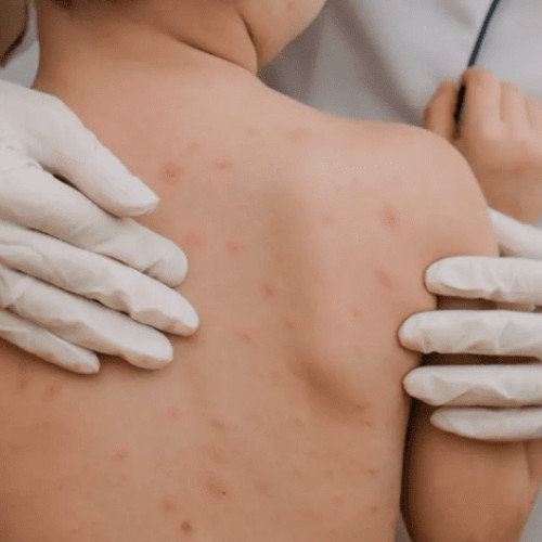 Rujeola în România rămâne o problemă de sănătate publică