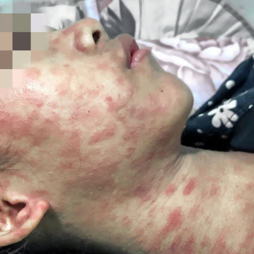 China combate o epidemie de virus "chikungunya" în provincia Guangdong