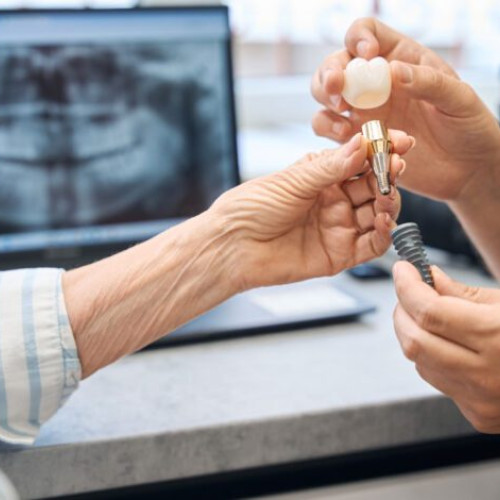 implanturi dentare rapide cu sistemul bredent: un pas spre zambetul perfect în 24 de ore