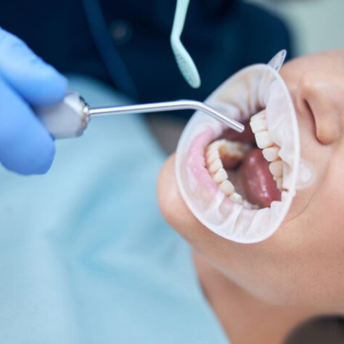 Importanța calității amprentei dentare în tratamentele protetice