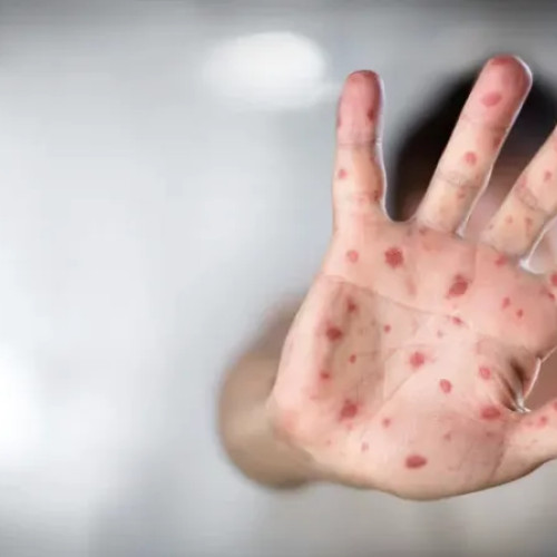 Rujeola: 160 de cazuri raportate în august, majoritatea în Cluj