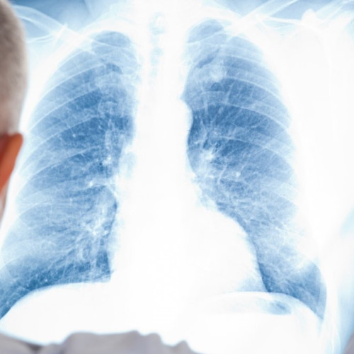 Screening TB în Botoșani: caravană mobilă pentru depistare precoce a tuberculozei