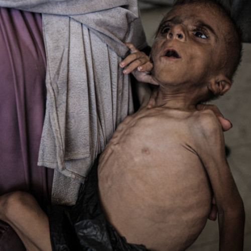 Criză de malnutriție în Gaza: peste 7.000 de copii sub cinci ani în programe de recuperare