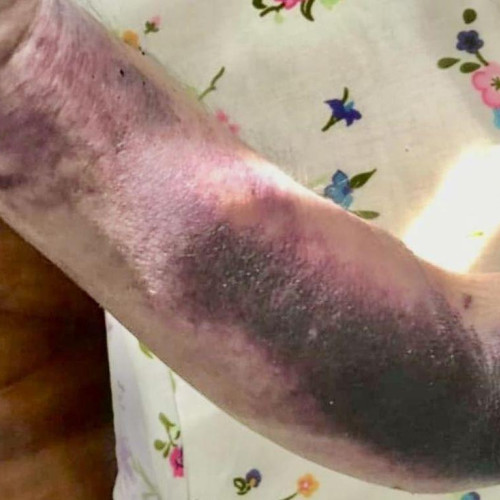 Asistentă medicală din Cluj avertizează asupra unei proceduri greșite în timpul unei puncții arteriale