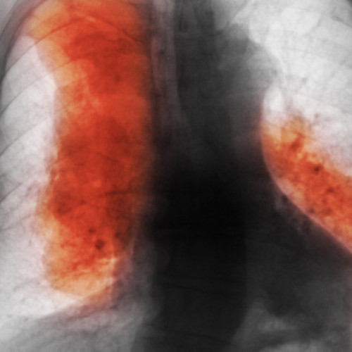 Decesele cauzate de cancer la nivel mondial ar putea ajunge la 18,5 milioane în 2050