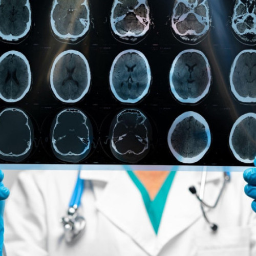 Boala rară cauzată de implantul unei membrane de cadavru, o condamnare pentru o femeie