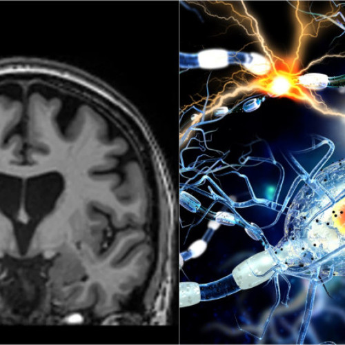 Tratament inovator încetinește cu 75% evoluția bolii Huntington