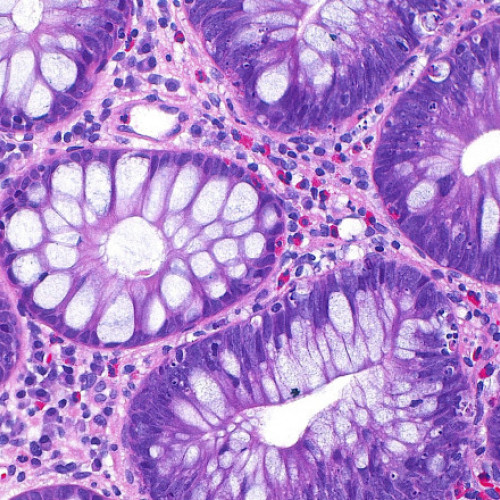 Crește numărul tinerilor diagnosticați cu cancer colorectal din cauza alimentației