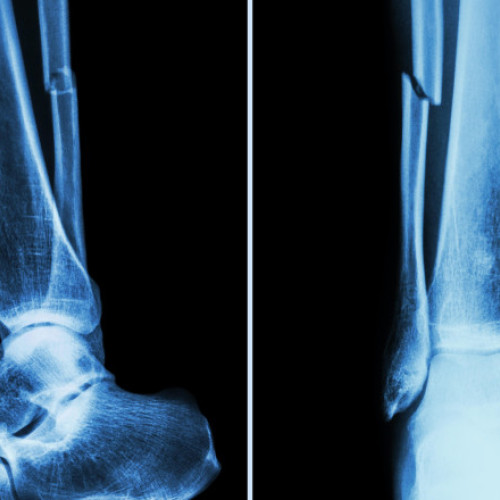 Cercetătorii chinezi dezvoltă un adeziv osos inovator pentru tratamentul fracturilor