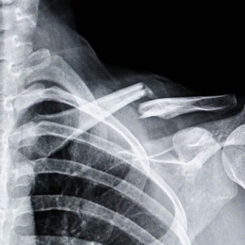 Cercetătorii chinezi au creat un adeziv pentru repararea rapidă a fracturilor osoase