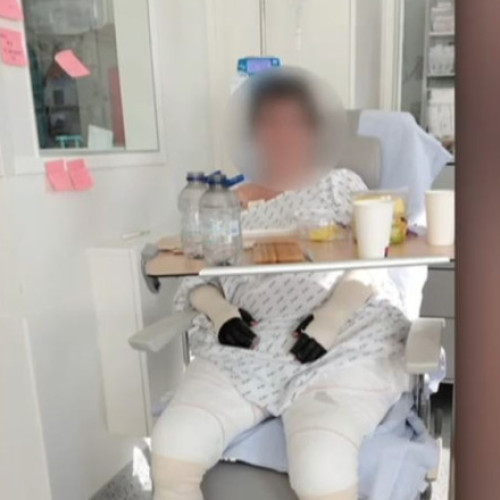 Pacienta cu arsuri grave de la Floreasca, externată după tratament în Belgia