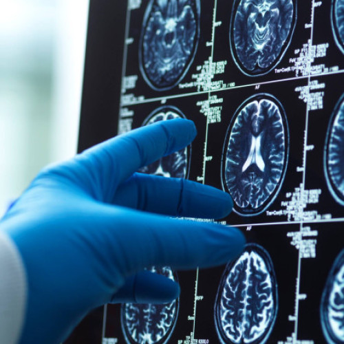 Creierul bărbaților se micșorează mai rapid, dar Alzheimer afectează mai multe femei