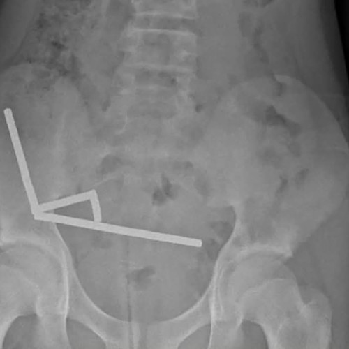 Băiat din Noua Zeelandă pierde o parte din intestin după ce a înghițit magneți puternici