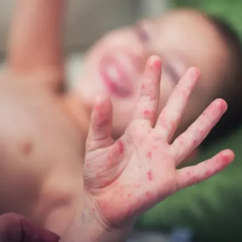 Creștere a cazurilor de rujeolă în România, inclusiv în județul Buzău