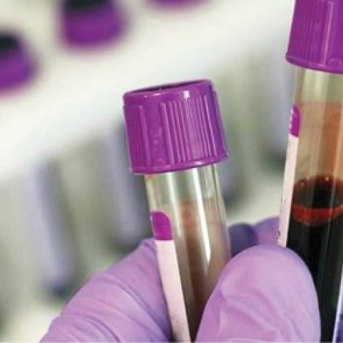 Analiza profilului lipidic recomandată pentru adulții peste 50 de ani