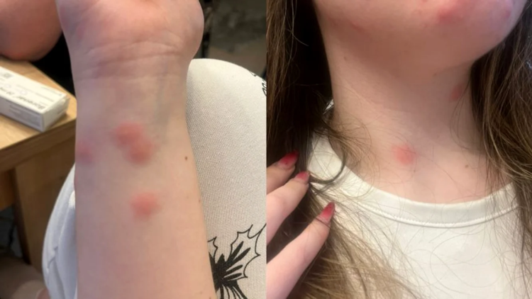 O tânără mușcată de ploșnițe în trenul CFR către Sighet în 2025