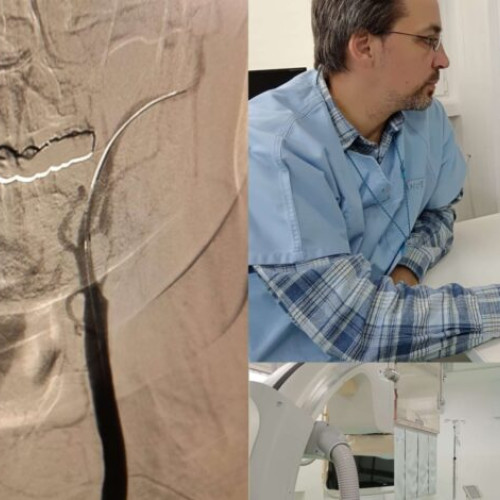 Premiere la Spitalul Județean Buzău: angioplastie carotidiană și subclavie realizate cu succes