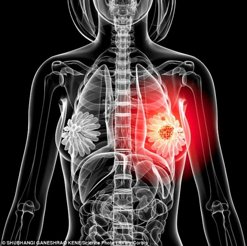 Malpraxis medical în Bremen: 34 de erori de diagnostic în cazul țesutului mamar