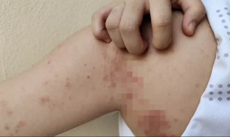 Confirmat primul caz de lepră în România după peste 40 de ani, la un salon din Cluj-Napoca